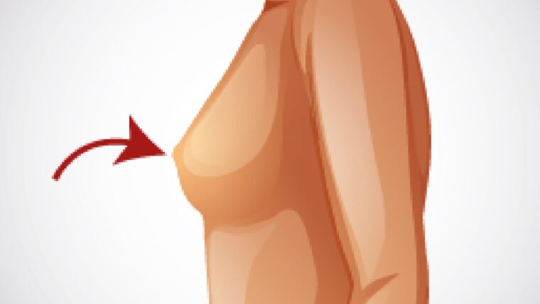 CORRECTION OF LARGE Nipples